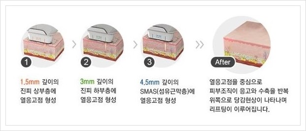 [두한성형외과 경쟁력 주름성형] - [HIFU 초음파 리프팅 주름교정술 안내 2.] 관련 이미지 2