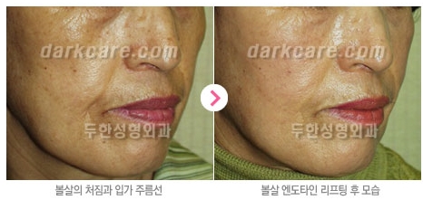 Duhan Plastic Surgery Combo Program - Dark Circles and Lifting image 14