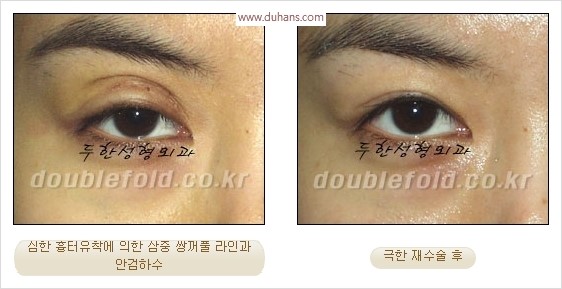[두한성형외과 경쟁력 눈성형] - [극한 재수술, 함몰된 눈꺼풀 라인교정, 안검하수(졸리운 눈매)] 관련 이미지 8