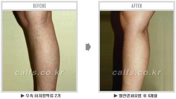 [종아리성형 두한성형외과] - [종아리수술에 대한 자주하는 질문과 답변 모음] 관련 이미지 2