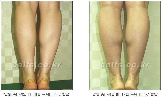 [두한성형외과 종아리성형] - [종아리 축소술 종류] 관련 이미지 2