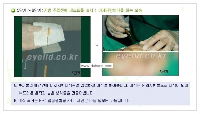 [두한성형외과 경쟁력 눈밑성형] - [다크써클 수술 안내 1.] 관련 이미지 8