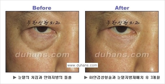 [두한성형외과의 상큼하고 환한 젊은 눈매완성] - [하안검 성형술 ①] 관련 이미지 4