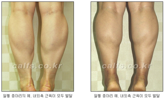 [두한성형외과 종아리성형] - [종아리 축소술 종류] 관련 이미지 1