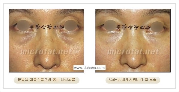 [두한성형외과 경쟁력 눈밑성형] - [눈밑 다크써클과 눈밑 함몰주름의 최적화 교정방법 안내] 관련 이미지 16