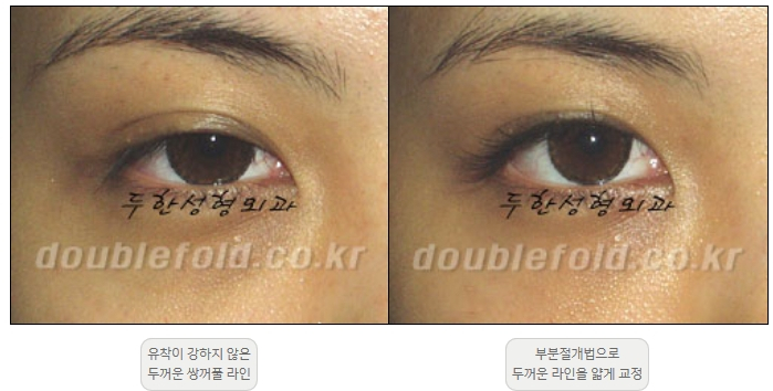 [Duhan Plastic Surgery Double Eyelid Revision] - [Thick Double Eyelid Line] image 29