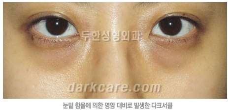 Duhan Plastic Surgery Dark Circle Improvement - What Causes Dark Circles? What Types of Dark Circles Are There? image 6