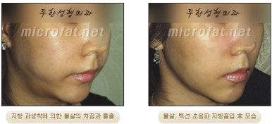 Facial Fat Liposuction at Duhan Plastic Surgery - Cheek Fat Liposuction, Jawline Liposuction, Under-Eye Fat Liposuction image 21