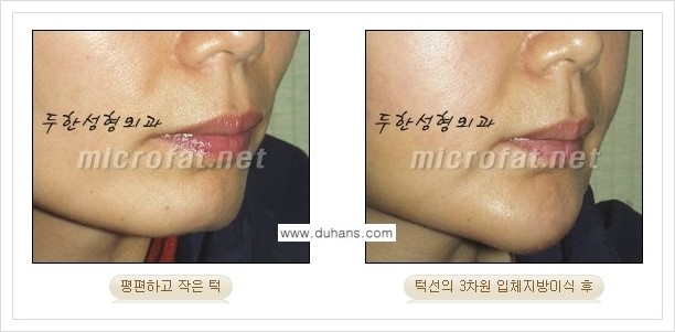 [두한성형외과 경쟁력 안면윤곽 교정] - [미세지방이식으로 무턱, 작은턱, 오목턱, 턱선의 비대칭 교정 안내] 관련 이미지 17