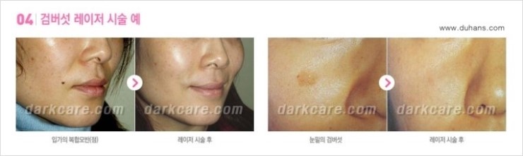 [두한성형외과 경쟁력 다크써클 치료] - [다크써클 + 검버섯 레이저 콤비 프로그램] 관련 이미지 6
