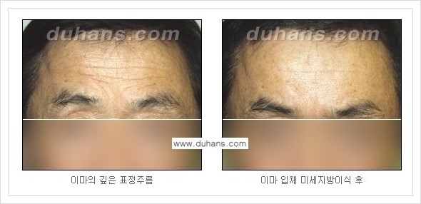 ​[두한성형외과 경쟁력 주름성형] - [주름교정을 위한 미세지방이식 안내 1.] 관련 이미지 13