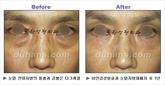 [두한성형외과 경쟁력 동안성형 리더] - ​[미간주름, 이마주름, 안검성형, 이마거상술, 눈썹거상술] 관련 이미지 118