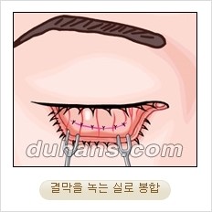 ⁠⁠[두한성형외과 경쟁력 안검성형] - [젊은 눈매를 위한 윗눈꺼풀 지방제거, 눈밑 지방제거] 관련 이미지 18