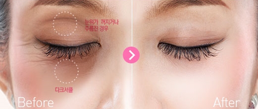 두한성형외과의 다크서클 + 눈위지방이식 콤비프로그램 관련 이미지 2