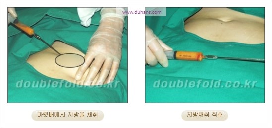 [두한성형외과 경쟁력 눈성형] - [쌍꺼풀 재수술 과정과 쌍꺼풀 재수술 실패의 원인, 쌍꺼풀 재수술의 성공 요건] 관련 이미지 21