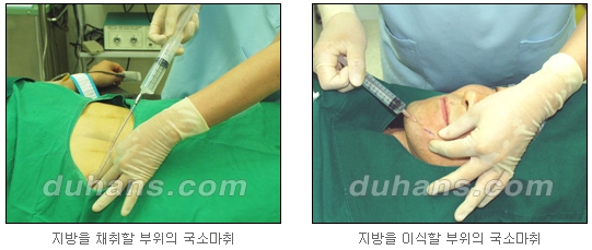 [두한성형외과 얼굴자가지방이식] - [지방이식 과정] 관련 이미지 11