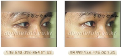 [두한성형외과 쌍커풀수술] - [쌍꺼풀지방이식] 관련 이미지 22