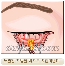 두한성형외과 지방제거 - 눈밑지방, 눈꺼풀지방제거 관련 이미지 16