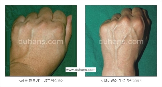 [두한성형외과 정맥 혈관 확장으로 인한 피부개선] - [손, 팔 혈관 확장] 관련 이미지 3