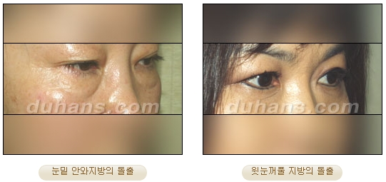 두한성형외과 지방제거 - 눈밑지방, 눈꺼풀지방제거 관련 이미지 1