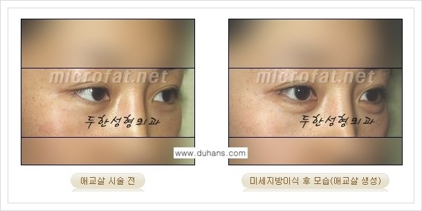 [두한성형외과 경쟁력 눈밑성형] - [애교살과 다크써클과의 관계] 관련 이미지 9