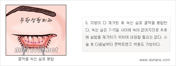 [두한성형외과 경쟁력 "지방제거"] - [눈 지방제거 1.] 관련 이미지 11