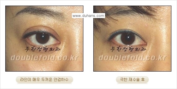 [두한성형외과 경쟁력 쌍꺼풀 재수술, 극한 눈재수술] - [망친 쌍꺼풀을 복원하는 극한 눈재수술] 관련 이미지 15