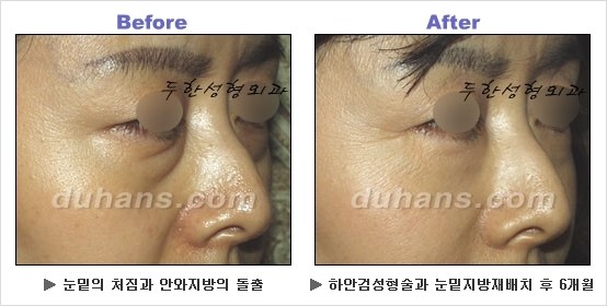 [두한성형외과 경쟁력 동안성형 리더] - ​[미간주름, 이마주름, 안검성형, 이마거상술, 눈썹거상술] 관련 이미지 89