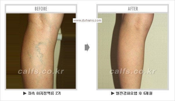 [두한성형외과 경쟁력 멀티종아리성형] - [지방흡입이 필요한 종아리 비만 안내] 관련 이미지 18