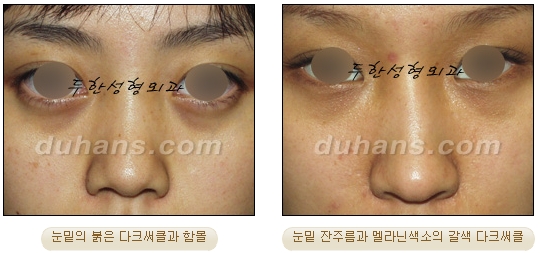 두한성형외과 눈밑성형 - 눈밑지방제거, 눈밑주름, 눈밑지방재배치 관련 이미지 56