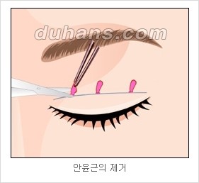 [두한성형외과 경쟁력 눈성형 리더] - [아름다운 눈매를 위한 쌍꺼풀 수술 안내] 관련 이미지 6