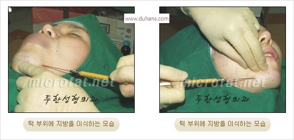 [두한성형외과 경쟁력 미세지방이식] - [무턱, 작은턱, 오목턱, 턱선의 비대칭 3차원 입체지방이식] 관련 이미지 11