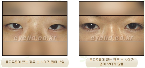 [두한성형외과 쌍커풀수술] - [눈성형 방법에 대한 자주하는 질문과 답변] 관련 이미지 138