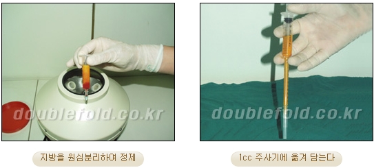 눈성형잘하는곳 두한성형외과 - 겹쌍꺼풀 관련 이미지 31