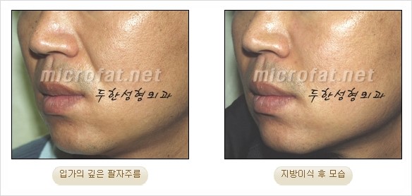 [두한성형외과 경쟁력 지방이식 리더] - [Col-fat(콜펫)지방이식, 3차원 입체지방이식, 2차원 평면지방이식] 관련 이미지 43