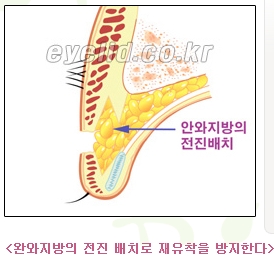 [두한성형외과 쌍꺼풀재수술] - [쌍꺼풀재수술성공요건, 쌍꺼풀재수술과정] 관련 이미지 6