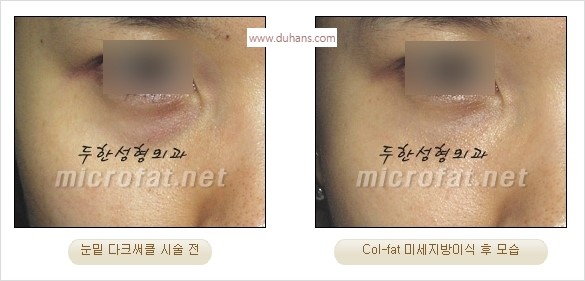 [두한성형외과 경쟁력 눈밑성형] - [다크써클 치료 전후 관리사항] 관련 이미지 21