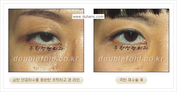 [두한성형외과 경쟁력 쌍꺼풀 재수술] - [극한의 상태에서 쌍꺼풀 재수술 안내 ②] 관련 이미지 12