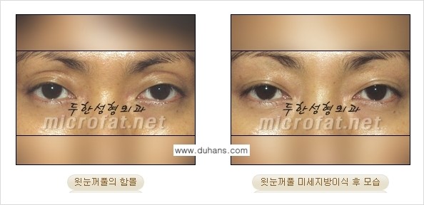 [두한성형외과의 경쟁력 NO.1 지방이식] - [눈꺼풀 미세지방이식 관련 자주하는 질문과 답변] 관련 이미지 2