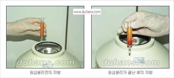 [두한성형외과 경쟁력 동안성형 리더] - ​[미간주름, 이마주름, 안검성형, 이마거상술, 눈썹거상술] 관련 이미지 3