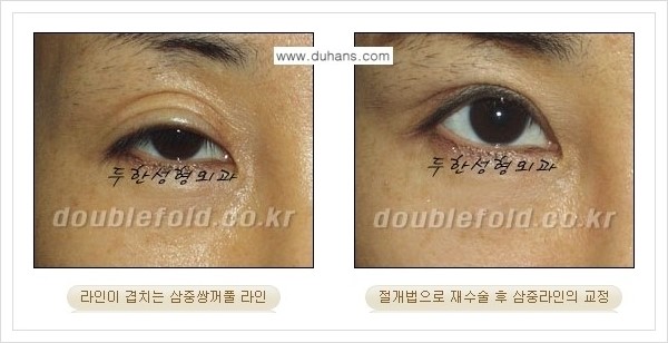 [두한성형외과 경쟁력 쌍꺼풀 재수술] - [삼중 쌍꺼풀 라인의 교정 안내] 관련 이미지 5