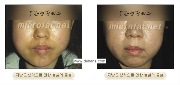 [두한성형외과] - [제대로 된 지방이식으로 부작용에서 탈출하자!] 관련 이미지 9