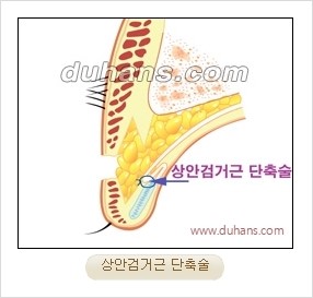 [두한성형외과 경쟁력 눈성형] - [완전절개법(Full incision method)의 재수술 과정] 관련 이미지 5