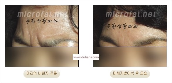 [두한성형외과 경쟁력 동안성형 리더] - ​[미간주름, 이마주름, 안검성형, 이마거상술, 눈썹거상술] 관련 이미지 23