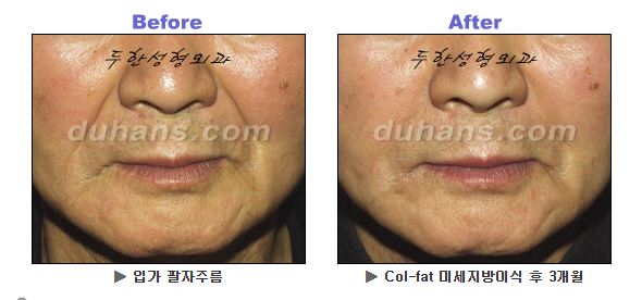 Nasolabial Fold Fat Grafting: How Can You Improve Fat Retention and Naturalness? image 2