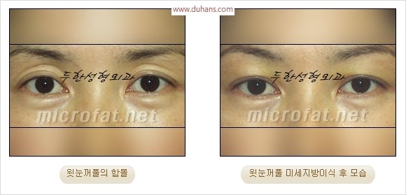[두한성형외과 경쟁력 눈성형 리더] - [윗눈꺼풀 함몰( #꺼진눈꺼풀) 미세지방이식과 상안검성형]#꺼진눈성형 , #눈위함몰 관련 이미지 12