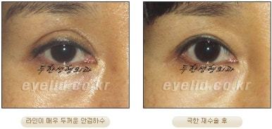 Duhan Plastic Surgery Ophthalmic Reoperation - What Is a Successful Double Eyelid Revision Surgery? image 30
