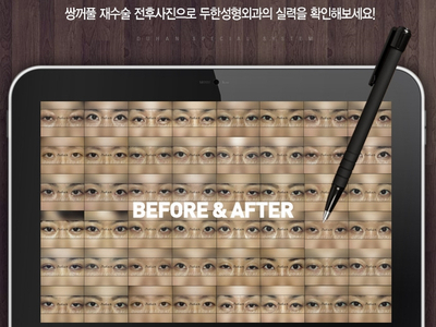 [두한성형외과 쌍커풀수술] - [눈성형 방법에 대한 자주하는 질문과 답변] 관련 이미지 216