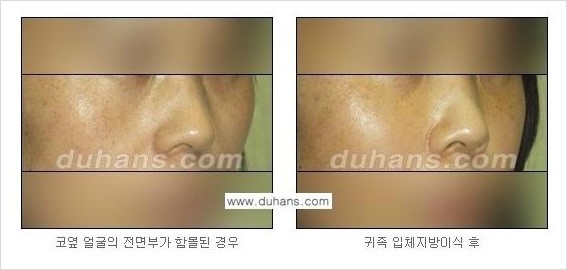 [두한성형외과 경쟁력 지방이식] - [귀족수술과 인디언밴드 윤곽성형] 관련 이미지 11