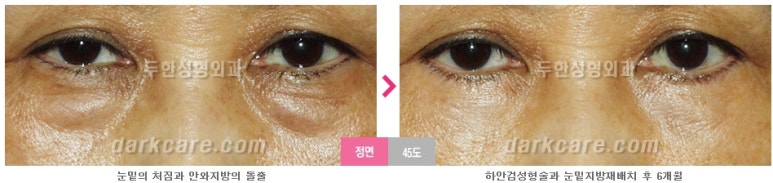 [두한성형외과 눈밑수술] - [눈밑지방재배치의 적응증] 관련 이미지 14